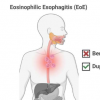 两项研究显示治疗嗜酸性食管炎的进展不一