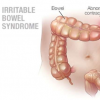 如何应对肠易激综合症