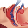 研究发现患有睡眠呼吸暂停的老年人住院的可能性更高