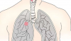 肺癌治疗在 III 期试验中产生无进展生存结果