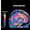 扫描显示更年期期间大脑的雌激素活性发生变化