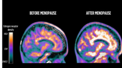 扫描显示更年期期间大脑的雌激素活性发生变化