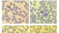 科学家在疟疾患者血液样本中发现与复发相关的分子