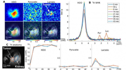 新的 MRI 方法利用改变的葡萄糖来点亮胰腺癌