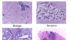 人工智能系统诊断乳腺癌准确率接近 100%