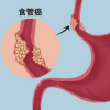 科学家在食道癌的认识上迈出了一步