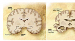 大脑葡萄糖水平越高可能意味着阿尔茨海默病越严重