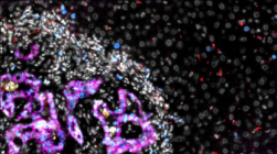 研究人员揭示结直肠癌细胞如何在肝脏中定植
