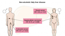 非酒精性脂肪肝疾病会增加罹患肝癌 结直肠癌和乳腺癌的风险