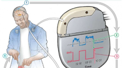 利用自我调节的脑起搏器治疗帕金森病